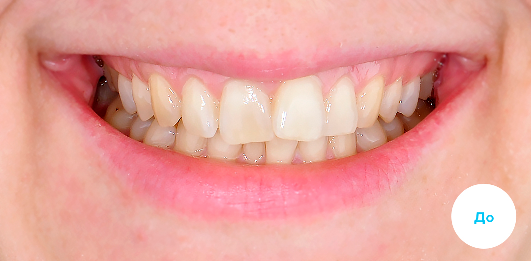 ЛЕЧЕНИЕ ПЕРЕКРЕСТНОГО ПРИКУСА, УСТРАНЕНИЕ СКУЧЕННОСТИ ЗУБОВ. 