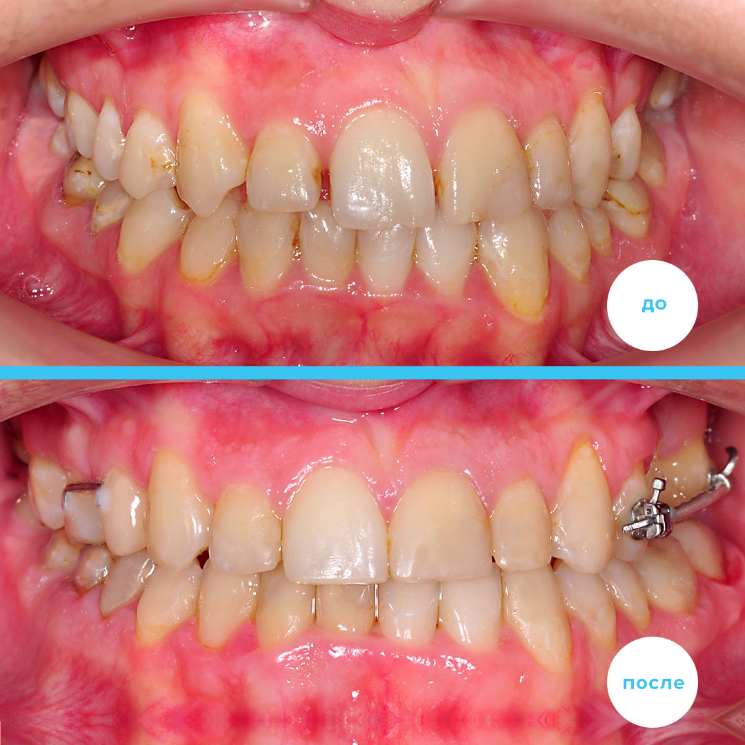 ОРТОДОНТИЧЕСКОЕ ПЕРЕМЕЩЕНИЕ СРЕДНЕЙ ЛИНИИ