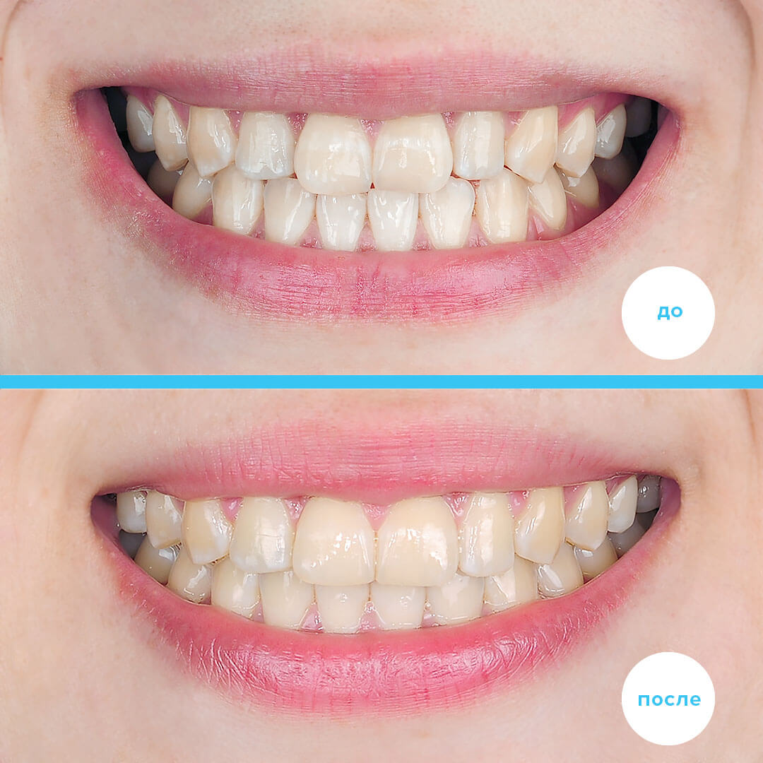 Результат лечения мезиального прикуса