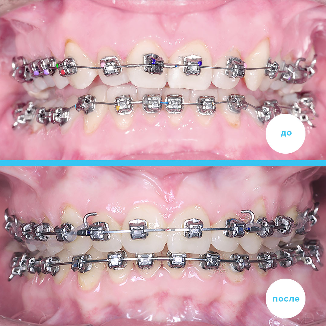 Результат лечения скученности без удаления зубов