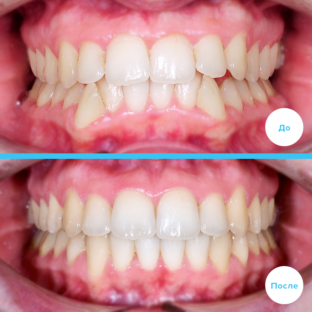 ЛЕЧЕНИЕ ДЕФИЦИТА МЕСТА (СКУЧЕННОСТЬ, ИЗБЫТОЧНЫЙ НАКЛОН ЗУБОВ) БЕЗ УДАЛЕНИЯ