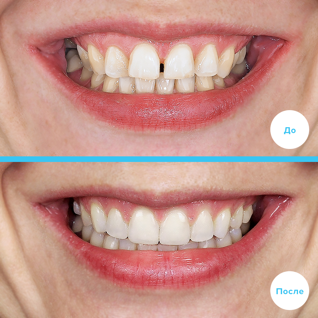 Лечение трех зубов