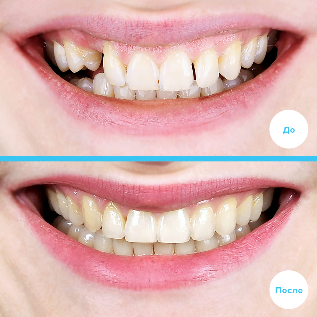 ЛЕЧЕНИЕ РЕТЕНЦИИ КЛЫКА С ПРИМЕНЕНИЕМ МИ