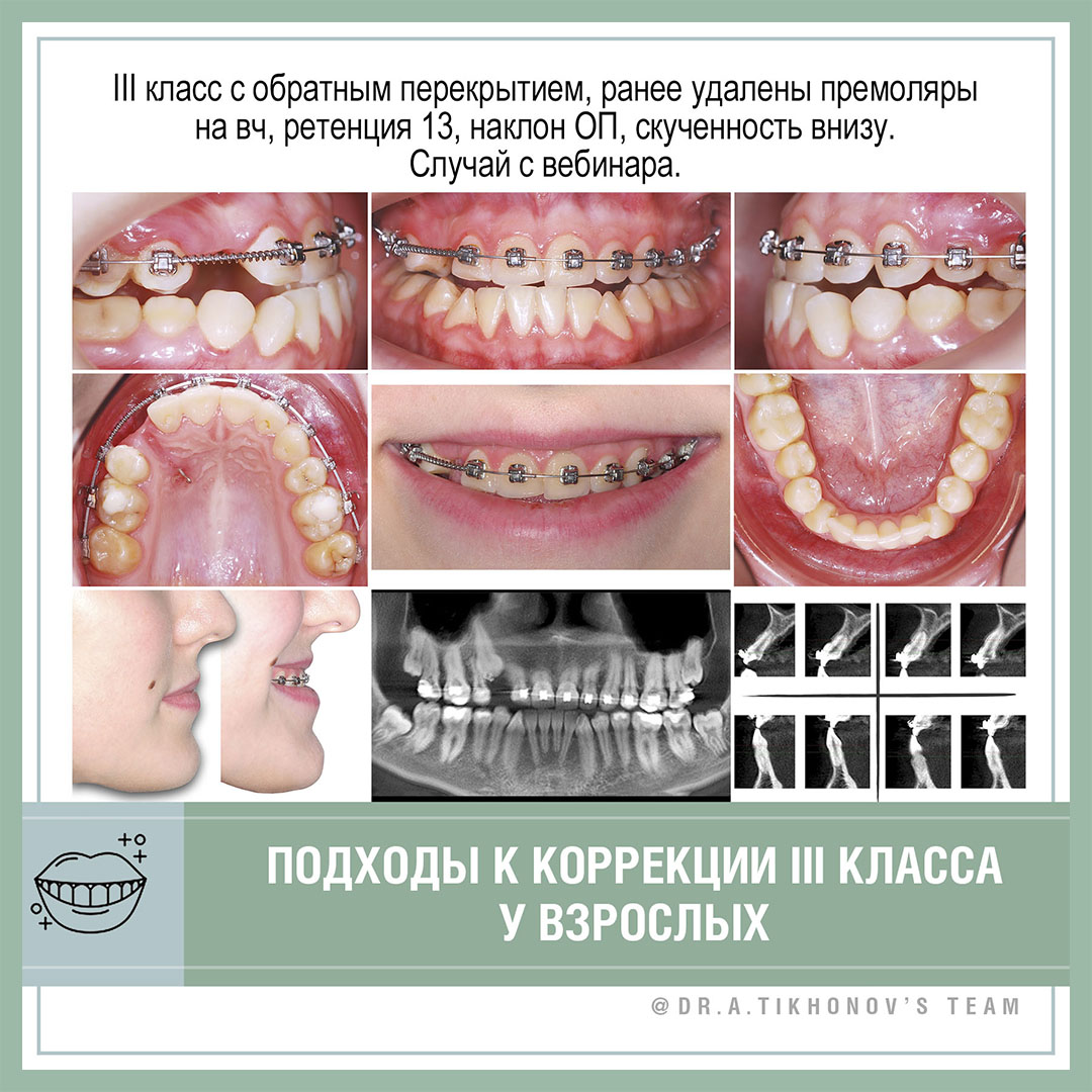 Подходы к коррекции III класса у взрослых