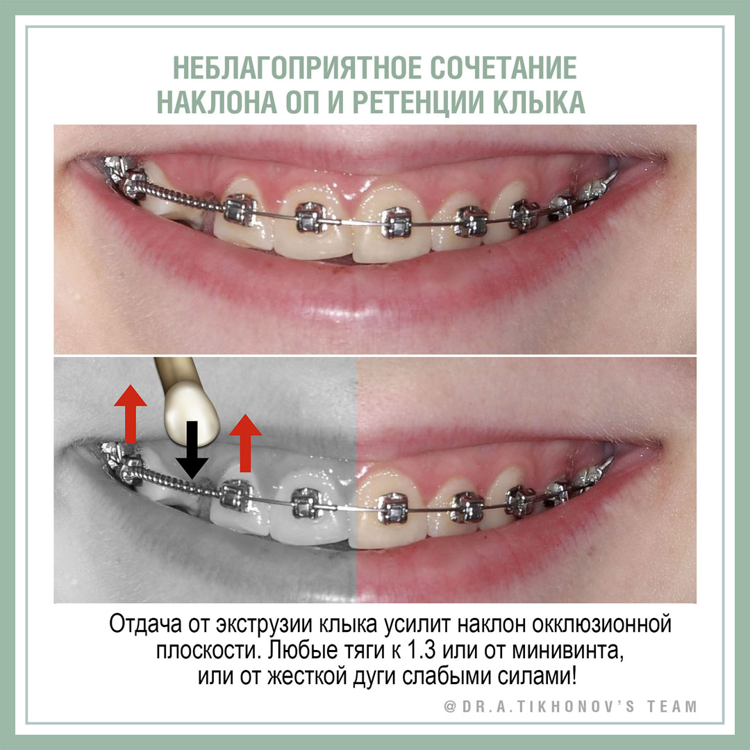 Неблагоприятное сочетание наклона ОП и ретенции клыка