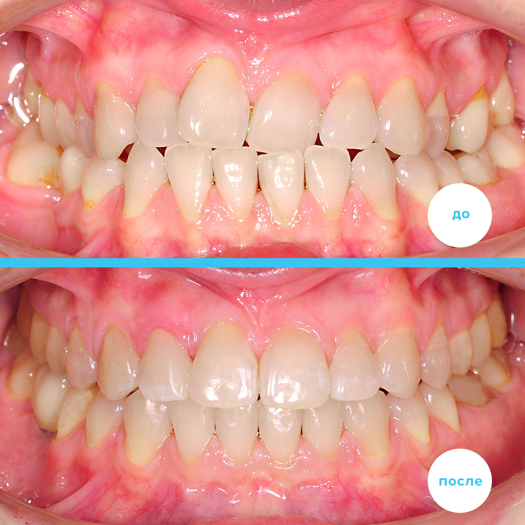 Результат лечения перекрестного прикуса