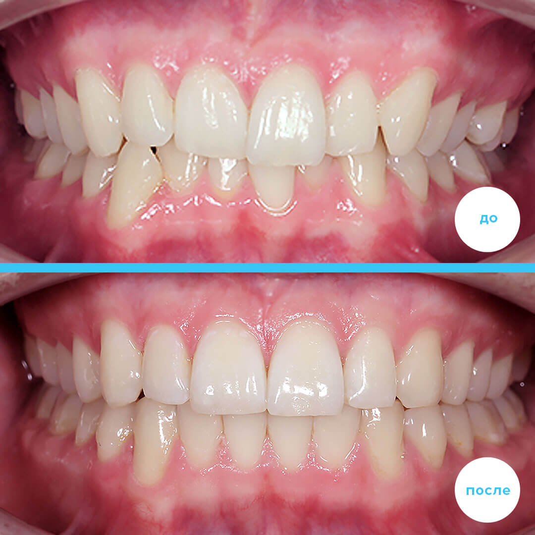 Лечение скученности без удаления зубов зубов