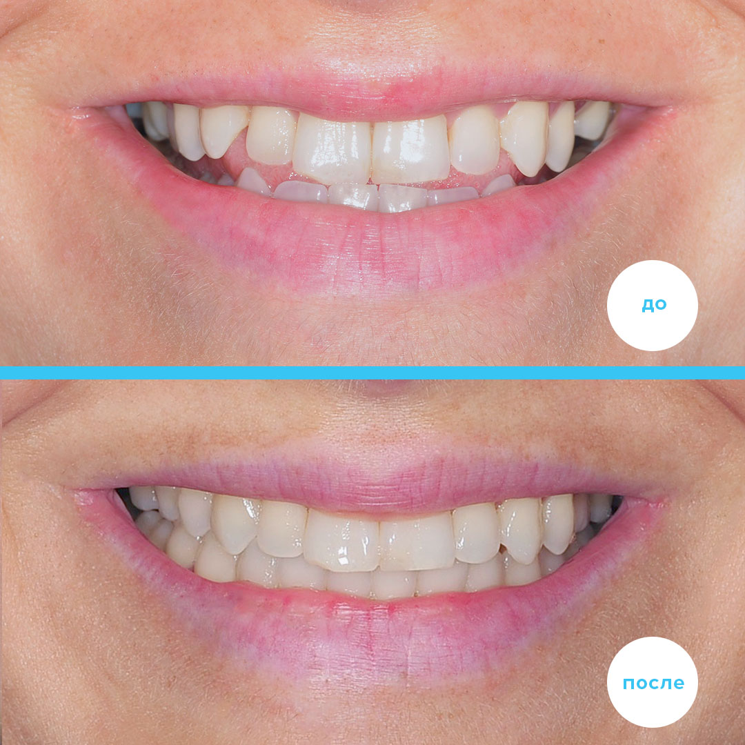 Результат комбинированного лечения мезиального прикуса