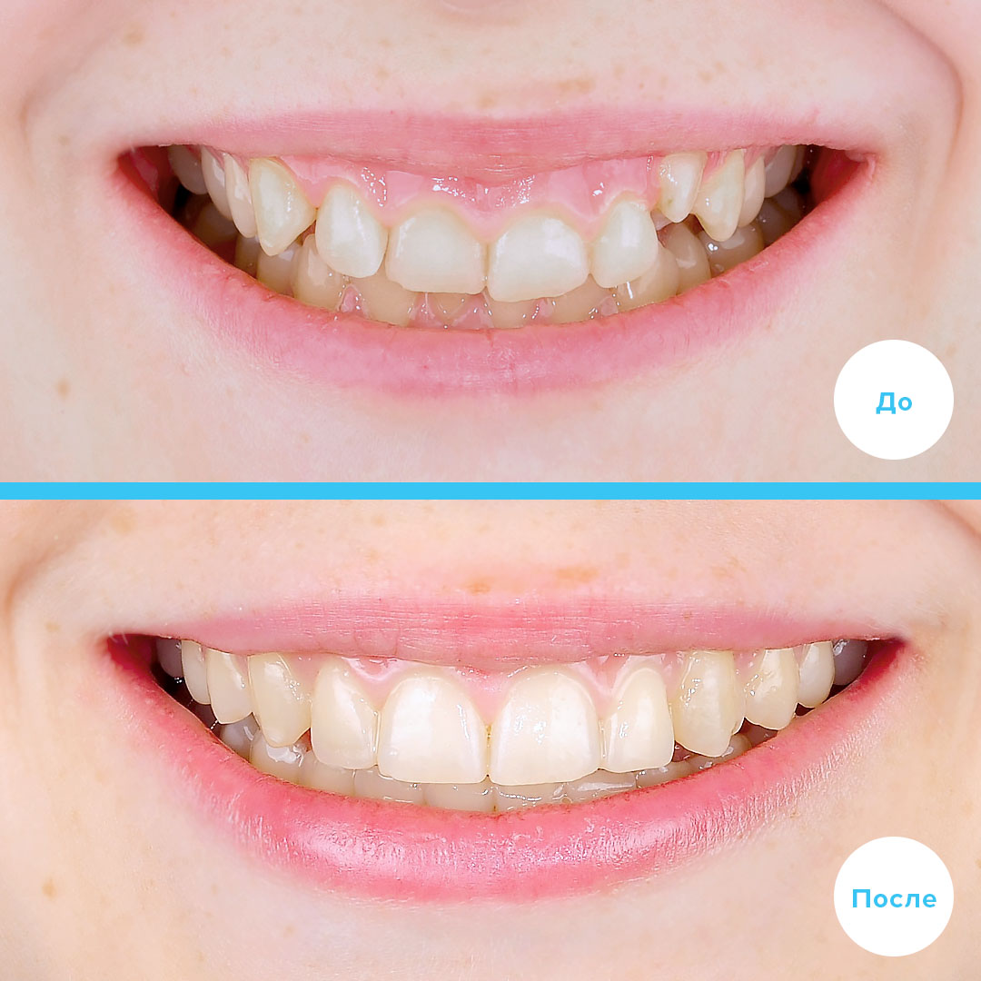 Коррекция скученности без удаления зубов