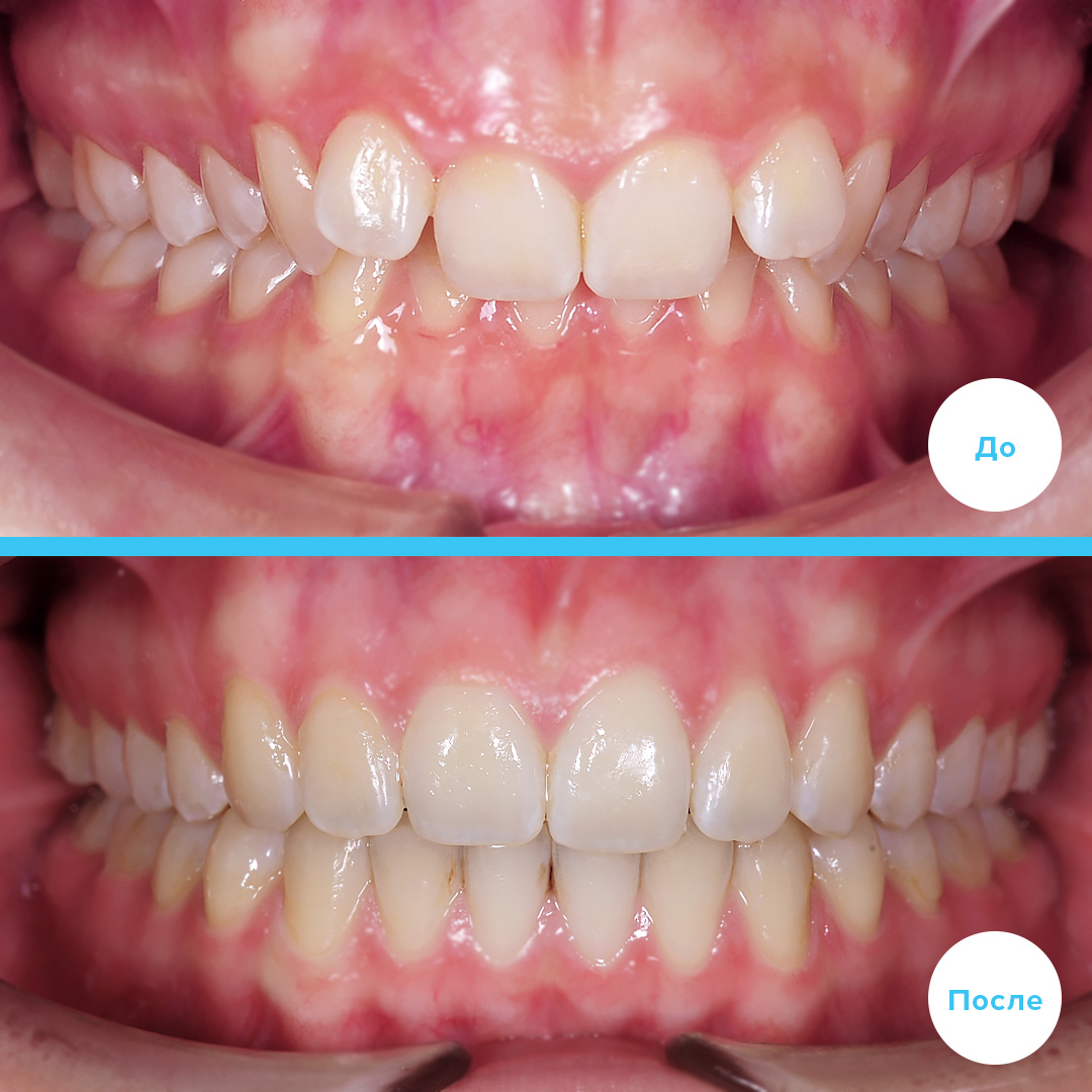 Результат лечения дистального прикуса аппаратом Гербста