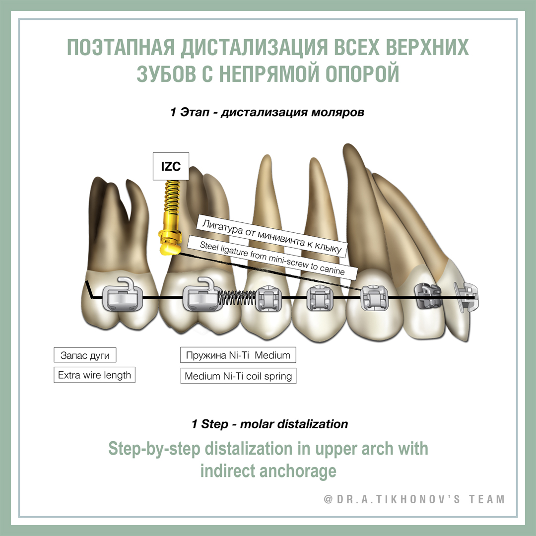 Поэтапная дистализация всех верхних зубов с непрямой опорой