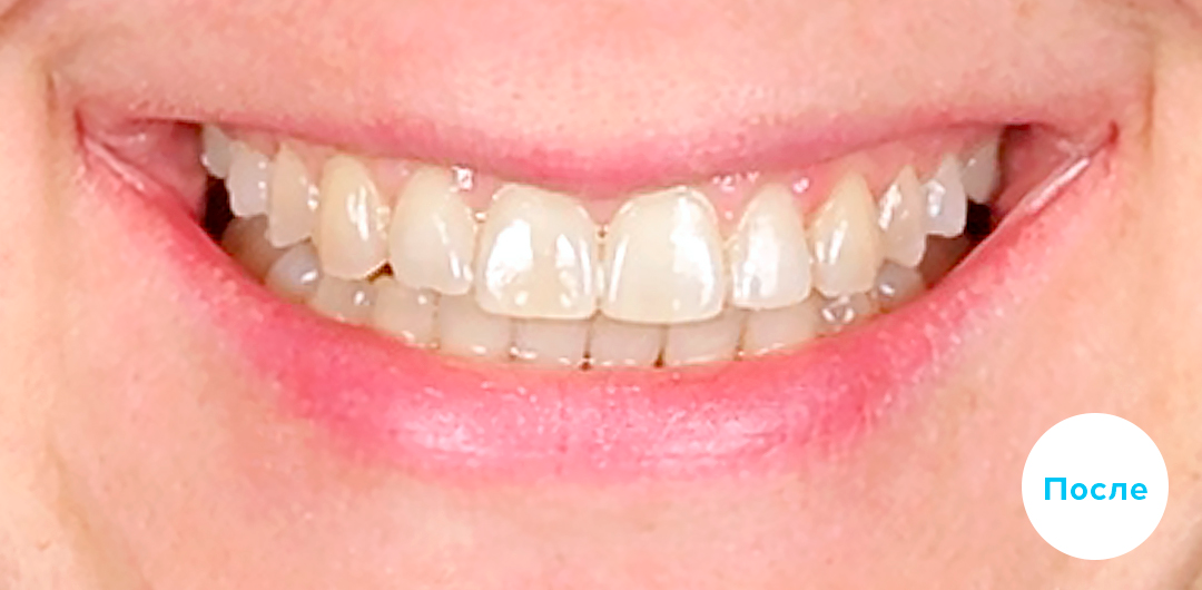 ЛЕЧЕНИЕ ПЕРЕКРЕСТНОГО ПРИКУСА, УСТРАНЕНИЕ СКУЧЕННОСТИ ЗУБОВ. 