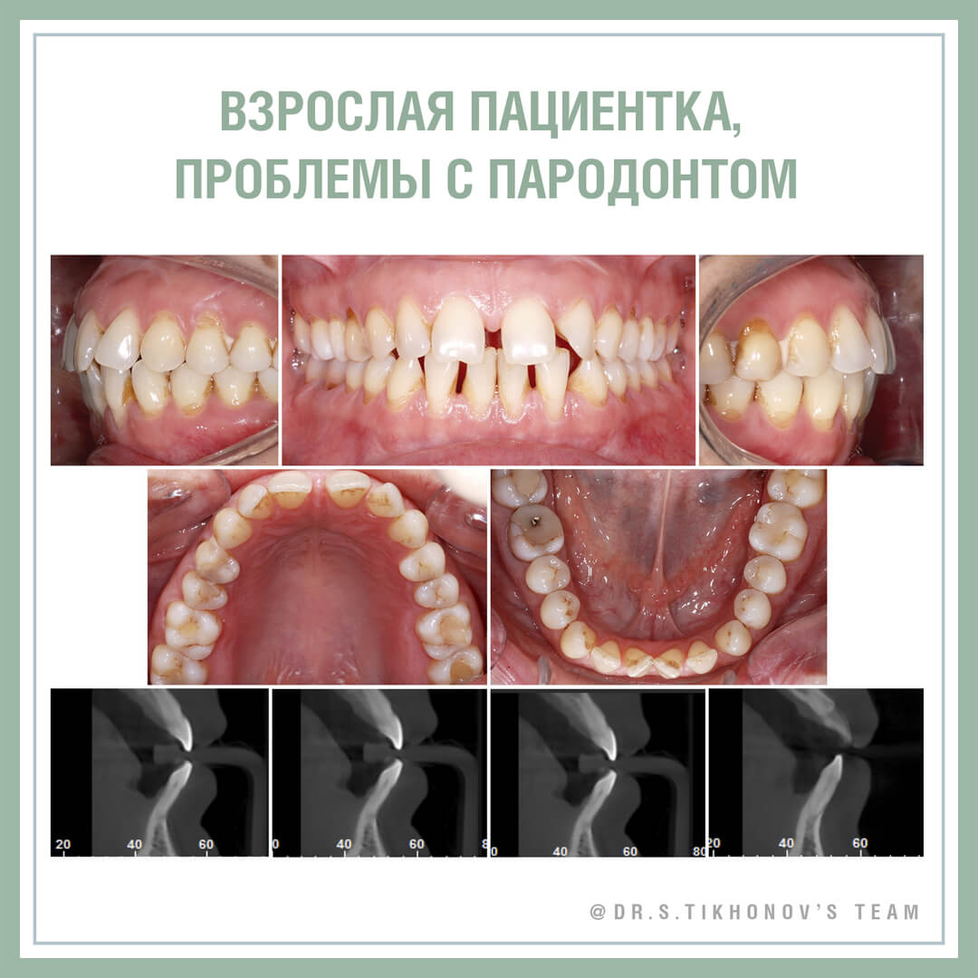 Взрослая пациентка, проблемы с пародонтом