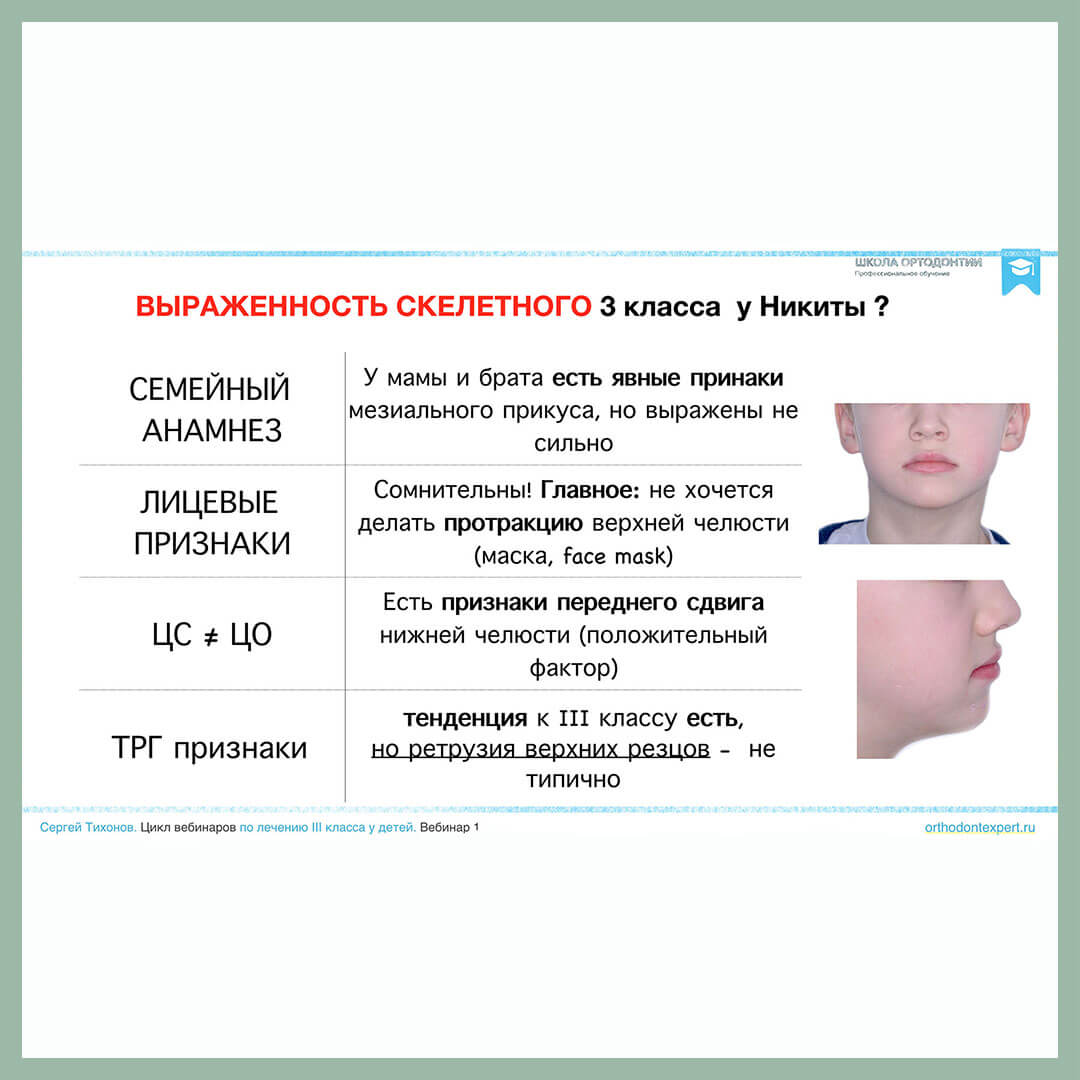 Выраженность скелетного 3 класса у Никиты