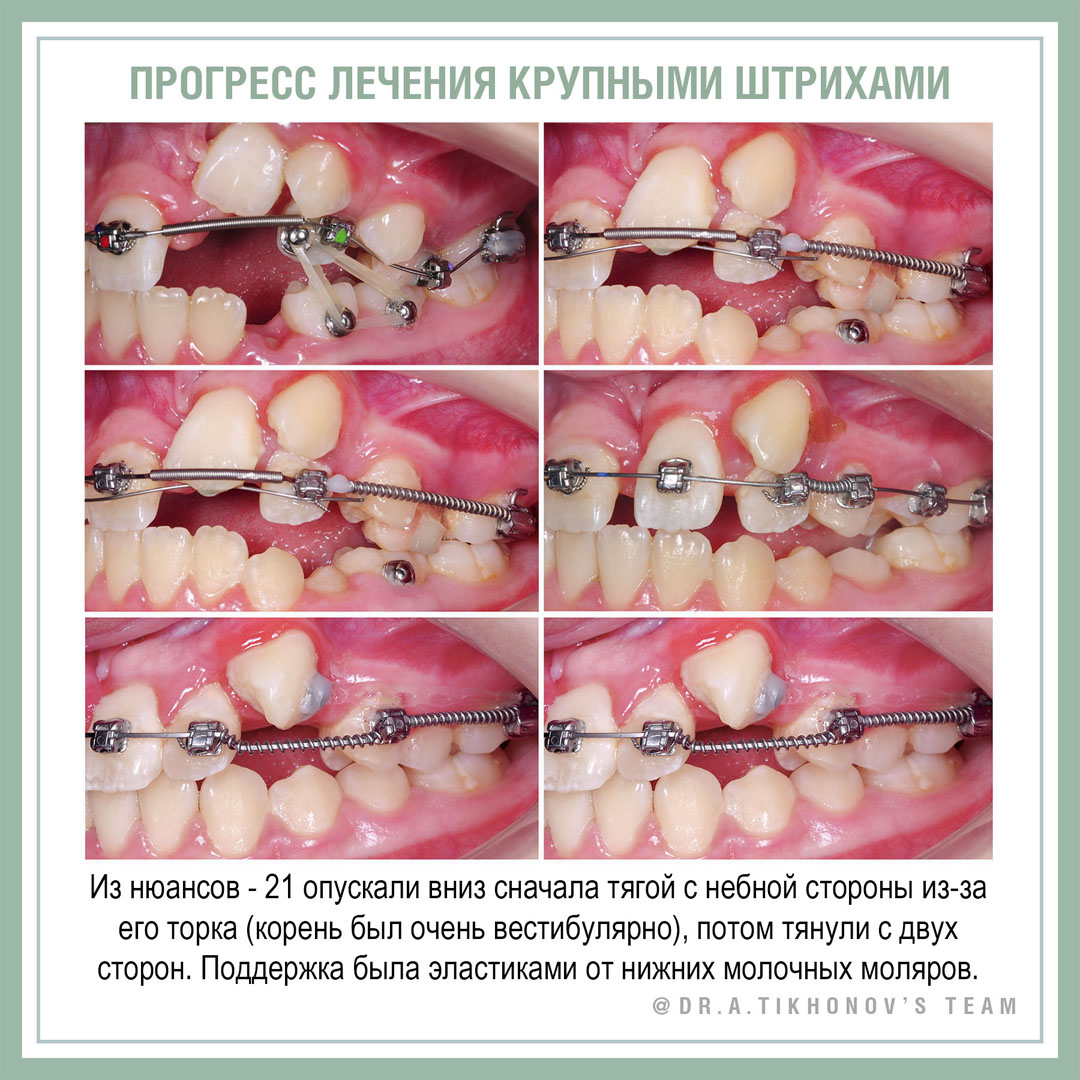 Прогресс лечения крупными штрихами
