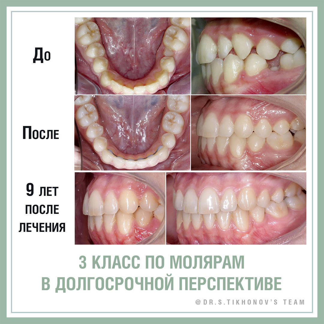 III класс по молярам в долгосрочной перспективе