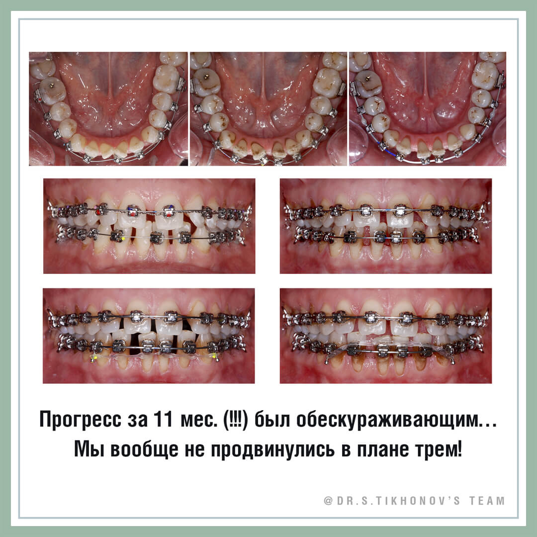 Прогресс за 11 месяцев был обескураживающим