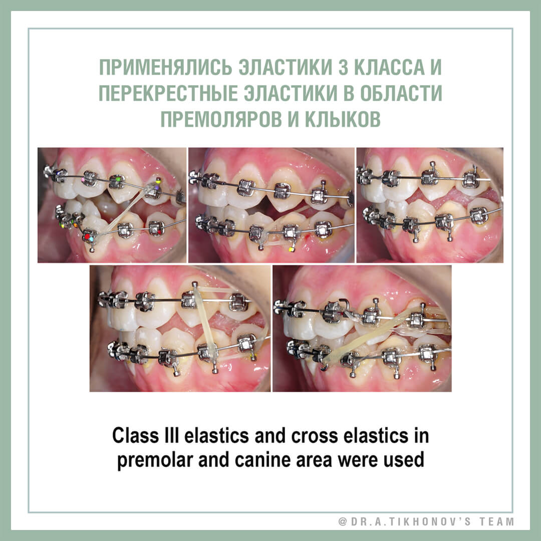 Применялись эластики 3 класса и перекрестные эластики в области премоляров и клыков