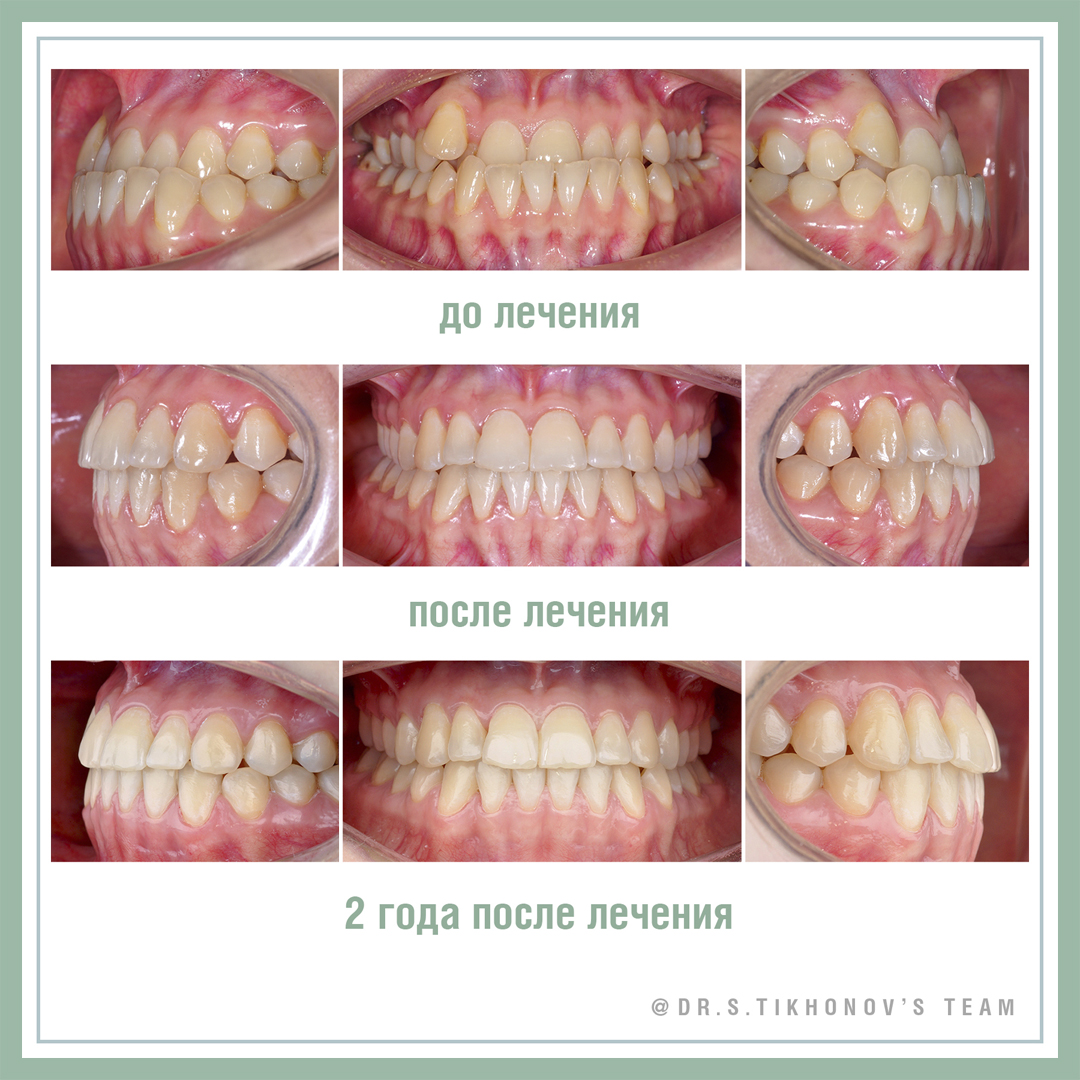 Как я лечил пациентку с обратным перекрытием