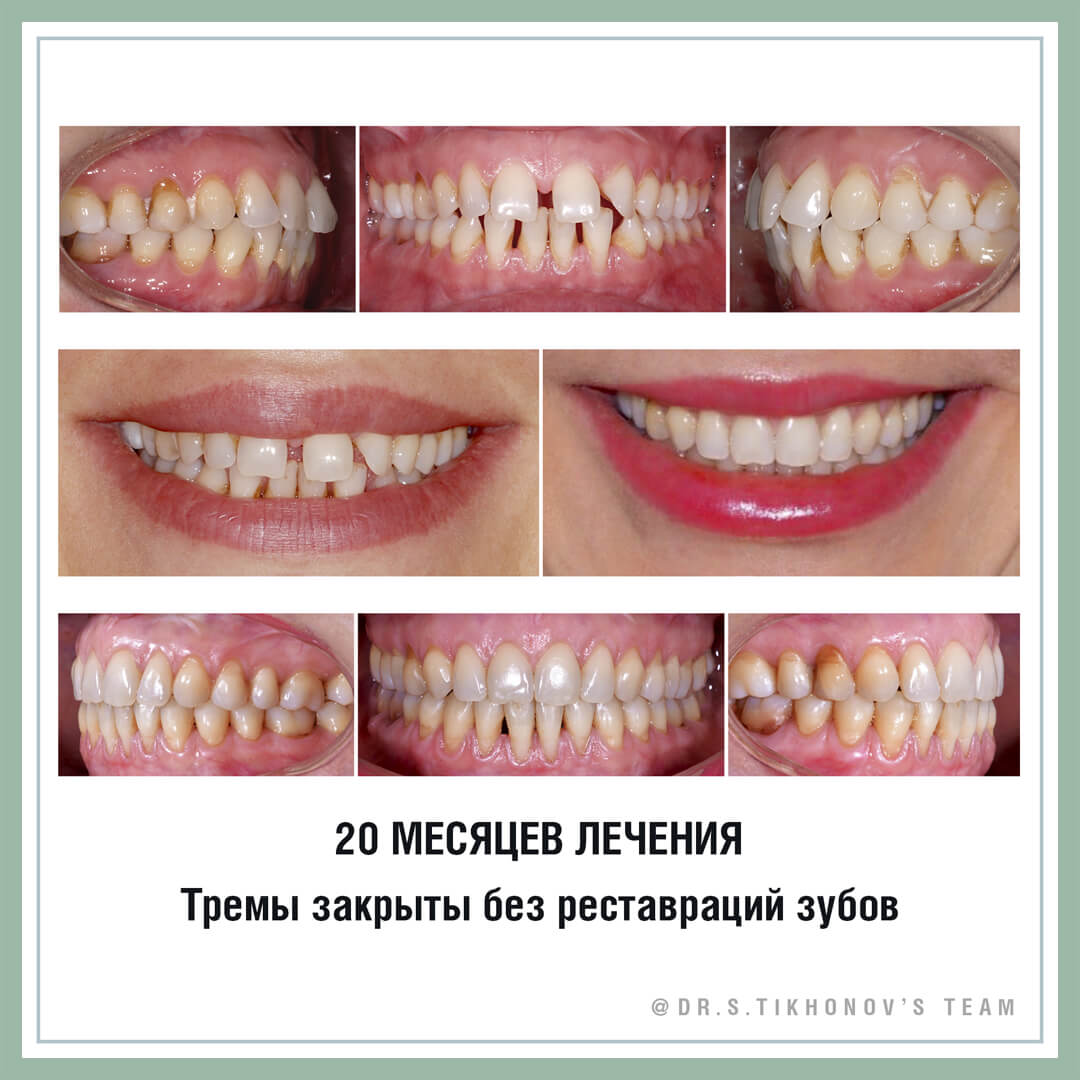 20 месяцев лечения. Тремы закрыты без реставрации зубов