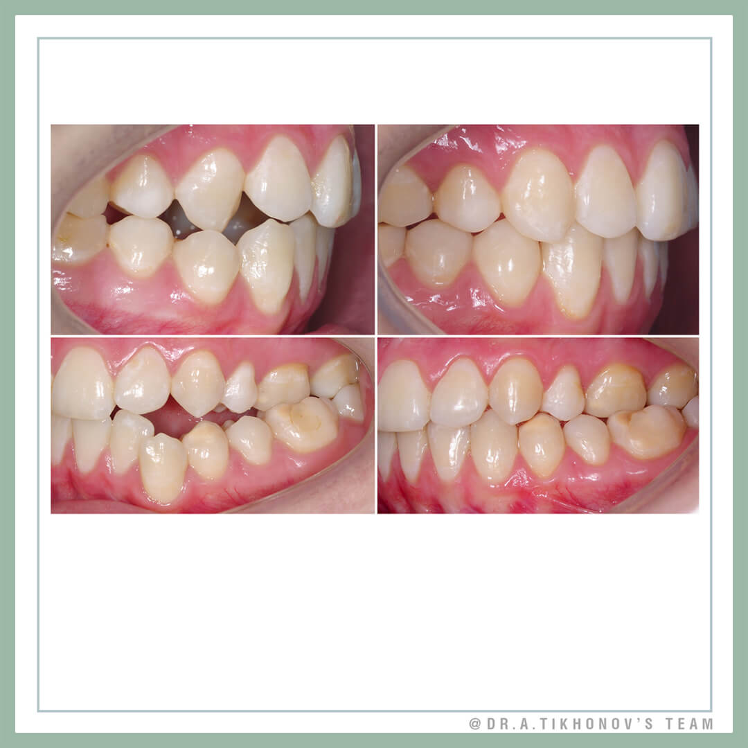 Компромиссное лечение в ортодонтии. Подумайте!