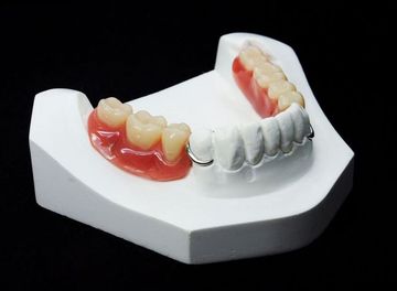 Бюгельное протезирование на имплантах