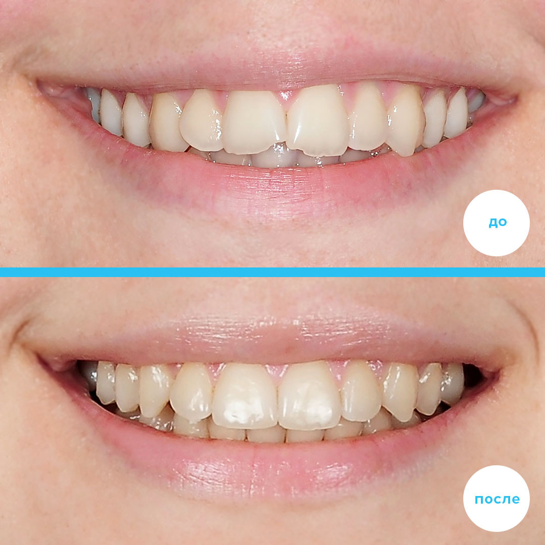 ЛЕЧЕНИЕ ДИСТАЛЬНОГО ПРИКУСА, ЗАКРЫТИЕ ПРОМЕЖУТКА ОТ ОТСУТСТВУЮЩЕГО НИЖНЕГО ЗУБА