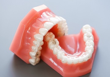 Исправление прикуса элайнерами - эстетика улыбки во время лечения