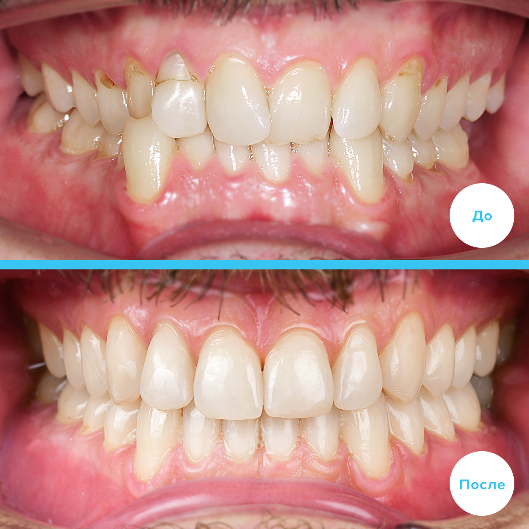 ЛЕЧЕНИЕ ПЕРЕКРЕСТНОГО ПРИКУСА, УСТРАНЕНИЕ СКУЧЕННОСТИ ЗУБОВ