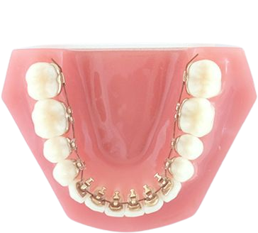 Установка брекетов с внутренней стороны зубов - революция в ортодонтии