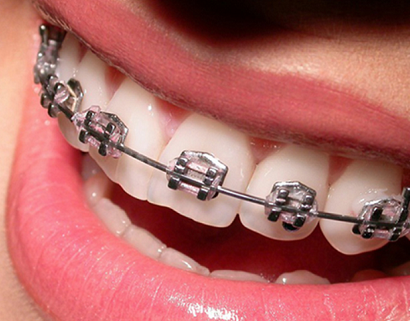 Виды брекетов - какие брекеты лучше
