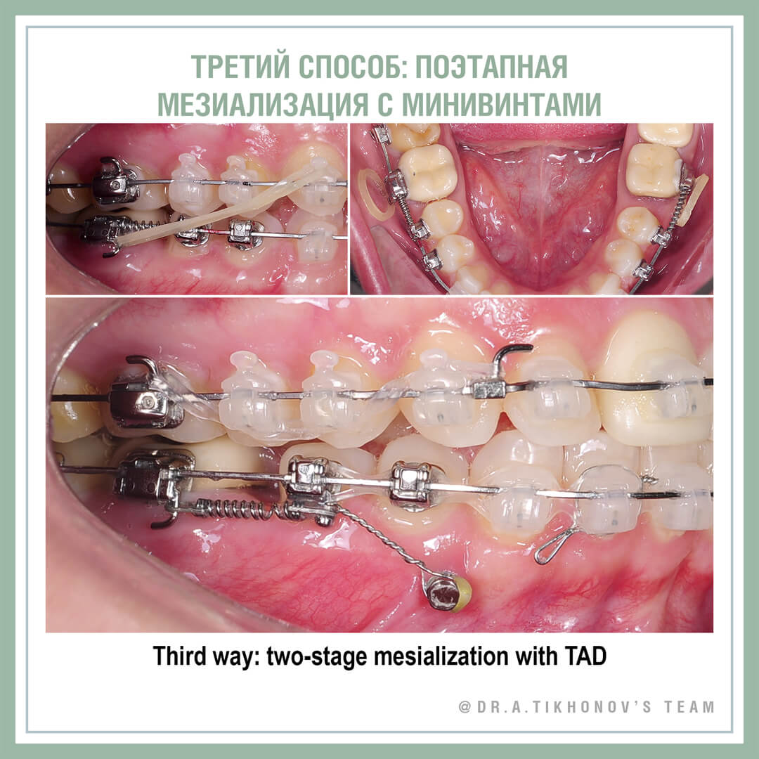 Третий способ: поэтапная мезиализация с минивинтами