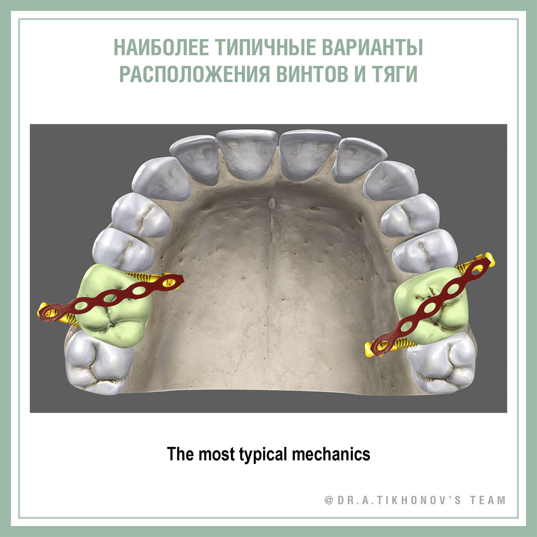10 советов по внедрению левого верхнего моляра
