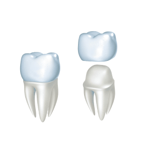 Мостовидное протезирование на имплантатах