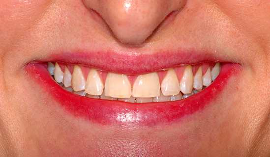 Брекет-система - шаг к красивой улыбке