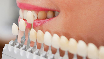 Виниры – плюсы и минусы