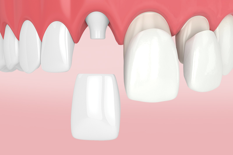 Коронки или виниры?