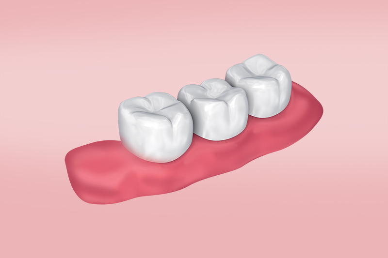 Облегченные съемные зубные протезы (акриловые, нейлоновые) - плюсы и минусы