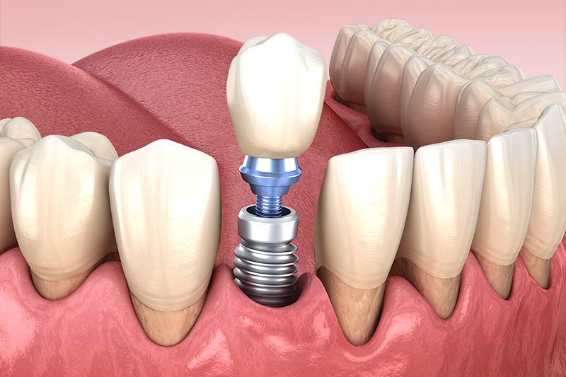 Съемное и несъемное протезирование зубов при пародонтозе: варианты