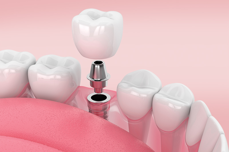 Виды коронок на импланты