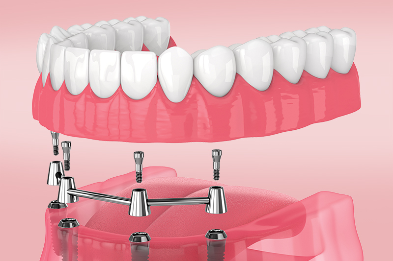 Съемное и несъемное протезирование при полном отсутствии зубов: в чем отличие