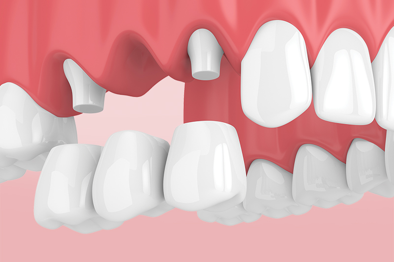 Частичное несъемное протезирование зубов: разновидности, плюсы и минусы, нюансы установки