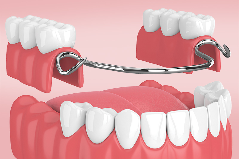 Протезирование при частичной адентии: съемные и несъемные зубные протезы