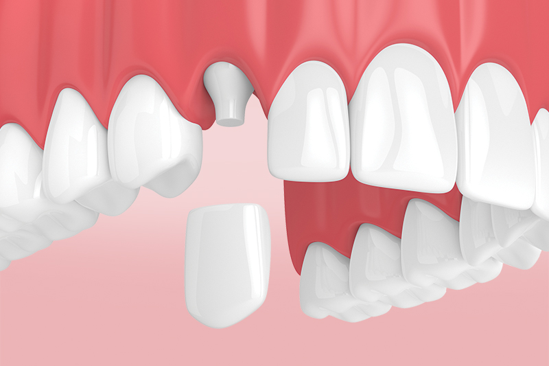 Коронки на зубы - какие лучше?