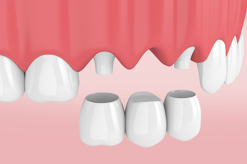 Протезирование зубов all on 2