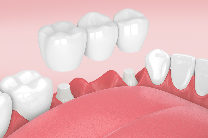Мосты на жевательные зубы: виды, цены, особенности