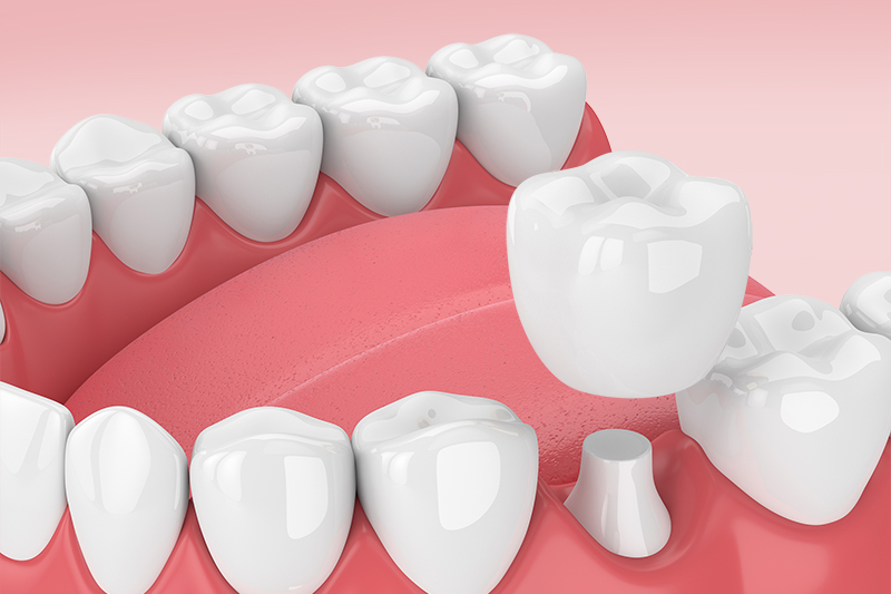 Штампованные зубные коронки: что это такое?