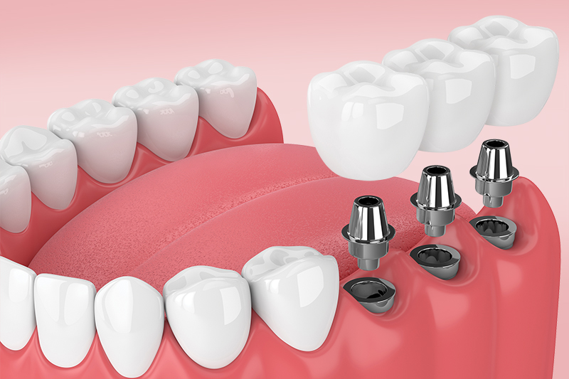Протезирование жевательных зубов коронками: варианты и стоимость