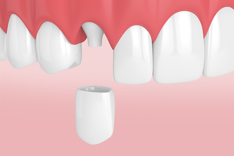 Выбрать коронки на здоровые зубы: цирконий или керамика?