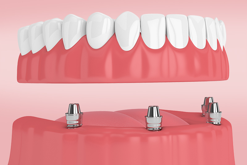 Несъемное протезирование на имплантатах: разновидности и альтернативы